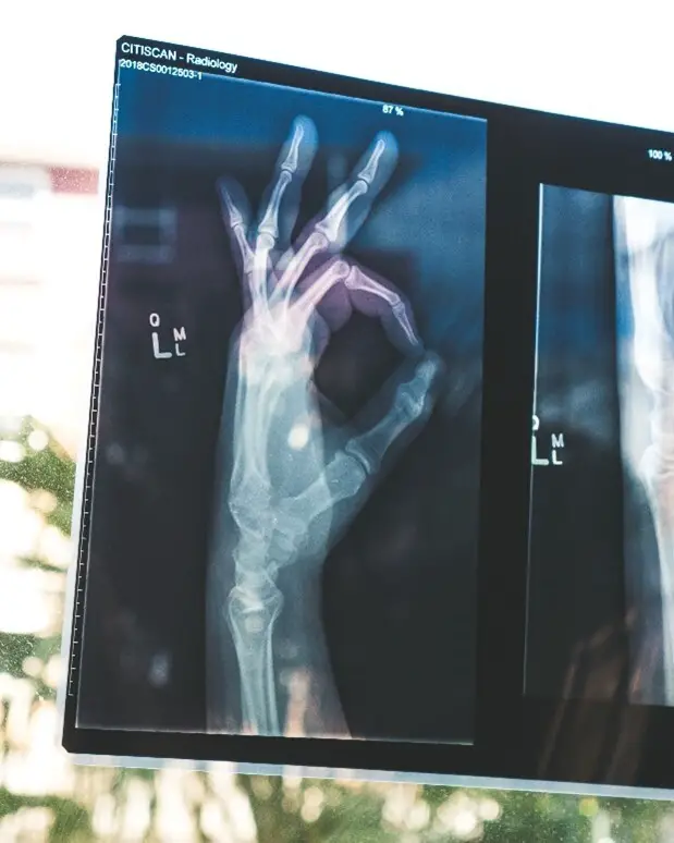 xray picture of a left hand
